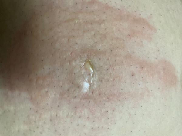 Bild zu Am Bauch verbrannt - Schwanger - wer noch? Rund um die Schwangerschaft