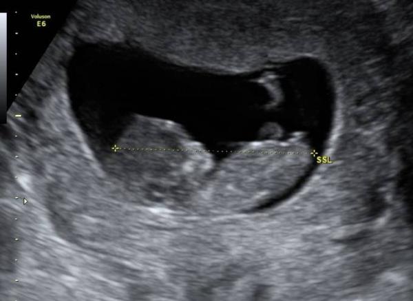 Bild zu Nasenbein und NUB - Schwanger - wer noch? Rund um die Schwangerschaft