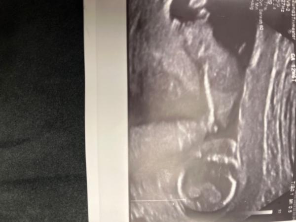 Bild zu Nub oder Skull Theorie möglich? - Schwanger - wer noch? Rund um die Schwangerschaft