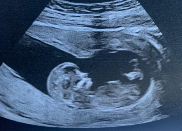 Bild zu Nub Theorie? Mädchen oder Junge 13 ssw - Schwanger - wer noch? Rund um die Schwangerschaft