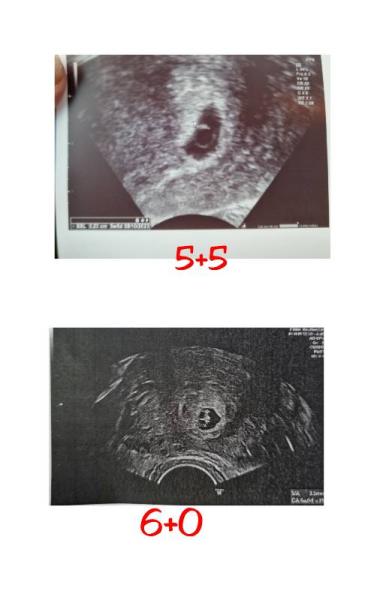 Bild zu 6+2 ssw Blutung - Schwanger - wer noch? Rund um die Schwangerschaft