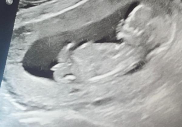 Bild zu Nabelschnur oder Junge?? - Schwanger - wer noch? Rund um die Schwangerschaft