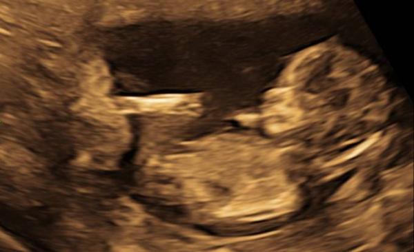 Bild zu Skull/Nub Theorie - Schwanger - wer noch? Rund um die Schwangerschaft