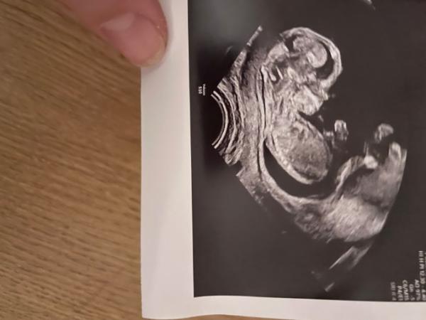 Bild zu Geschlecht Ultraschallbild erkennbar? - Schwanger - wer noch? Rund um die Schwangerschaft