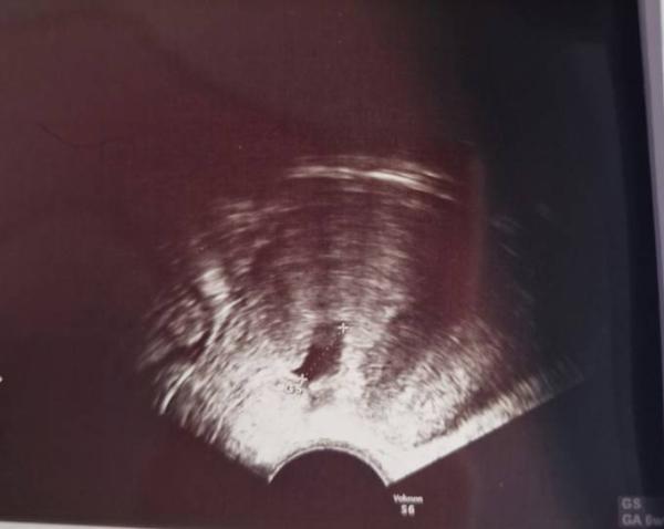 Bild zu 6+2 ssw - Schwanger - wer noch? Rund um die Schwangerschaft