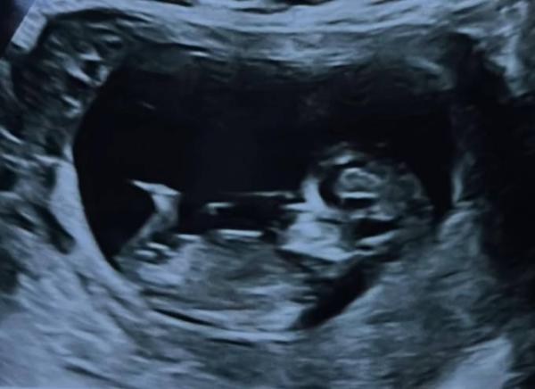 Bild zu Skull/Nub Theorie - Schwanger - wer noch? Rund um die Schwangerschaft