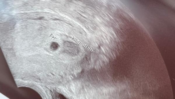 Bild zu 6ssw Ultraschallbild - Schwanger - wer noch? Rund um die Schwangerschaft