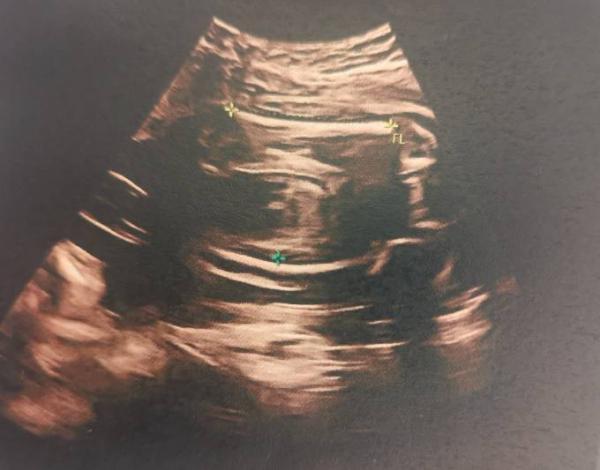 Bild zu Geschlecht SSW 26 - Schwanger - wer noch? Rund um die Schwangerschaft