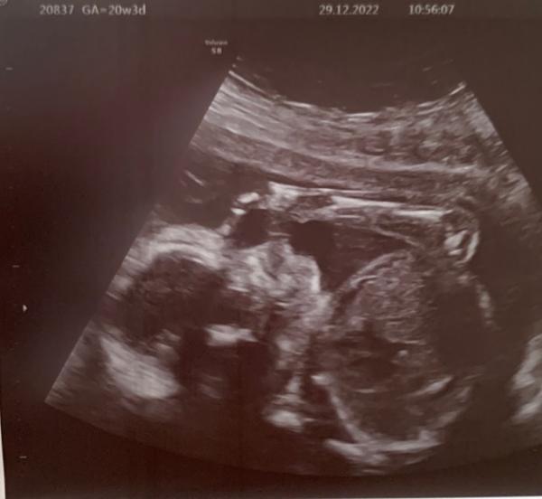 Bild zu Angst das etwas mit dem Baby was nicht stimmt Ultraschall - Schwanger - wer noch? Rund um die Schwangerschaft