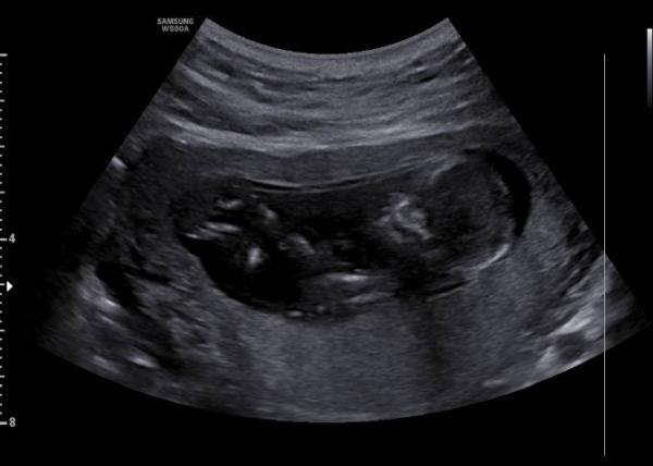 Bild zu Nub / Skull Theorie 13ssw zum mitraten - Schwanger - wer noch? Rund um die Schwangerschaft