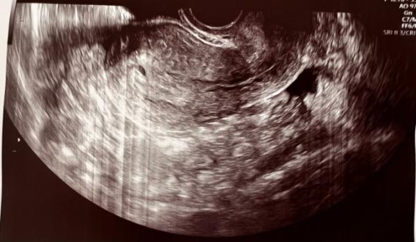 Bild zu US 4+2/ 4+6? - Schwanger - wer noch? Rund um die Schwangerschaft