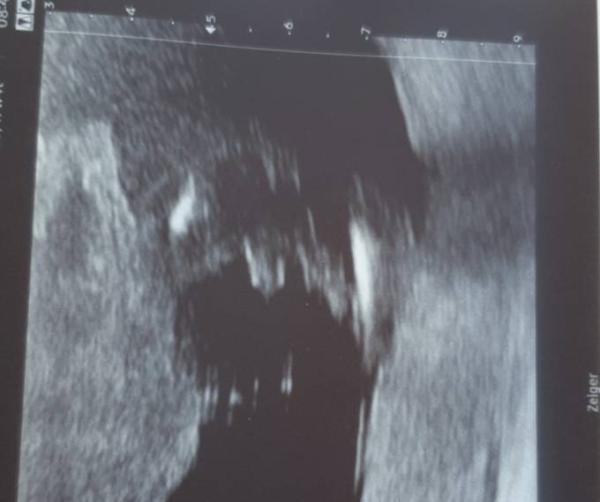 Bild zu Junge oder nur Nabelschnur? - Schwanger - wer noch? Rund um die Schwangerschaft