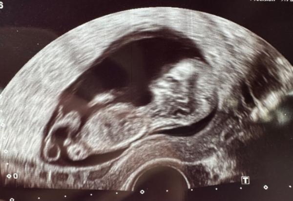 Bild zu Nub-Theorie? 12+0 SSW kann man das anwenden? - Schwanger - wer noch? Rund um die Schwangerschaft