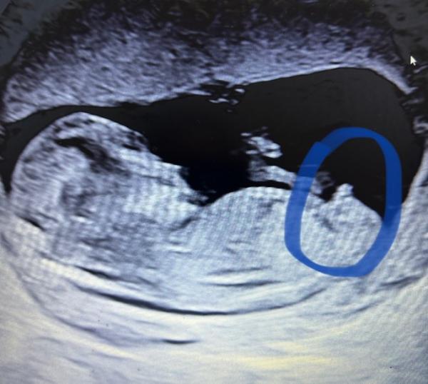 Bild zu 13ssw Geschlecht erfahren - Schwanger - wer noch? Rund um die Schwangerschaft