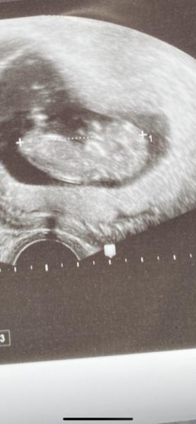 Bild zu Junge oder Mädchen? Was denkt ihr😊 - Schwanger - wer noch? Rund um die Schwangerschaft