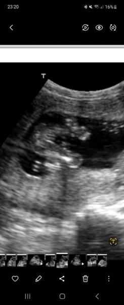 Bild zu Geschlecht 17 ssw - Schwanger - wer noch? Rund um die Schwangerschaft