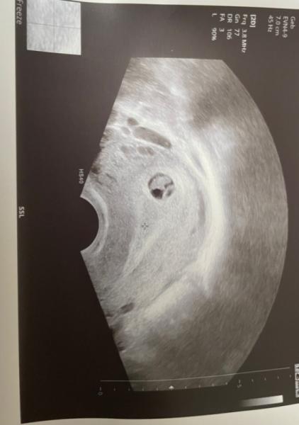 Bild zu Kleine Fruchthöhle / Embryo zeitgerecht - Schwanger - wer noch? Rund um die Schwangerschaft