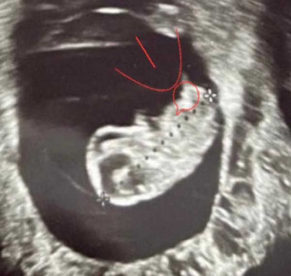 Bild zu Geschlecht schon erkennbar ? 😳 - Schwanger - wer noch? Rund um die Schwangerschaft