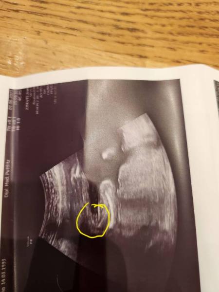 Bild zu Unsicher ob mädchen oder junge - Schwanger - wer noch? Rund um die Schwangerschaft