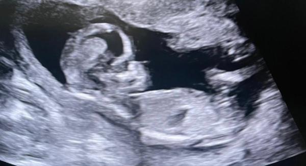 Bild zu Geschlecht erraten :-) - Schwanger - wer noch? Rund um die Schwangerschaft