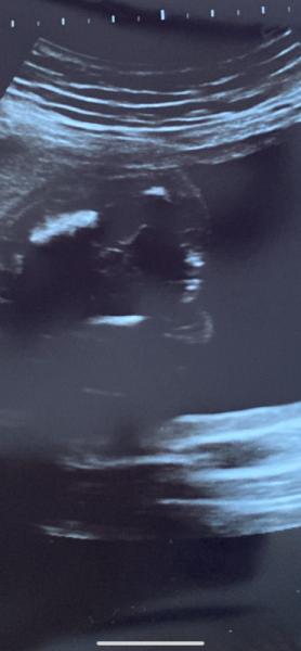 Bild zu Mädchen oder Junge? - Schwanger - wer noch? Rund um die Schwangerschaft