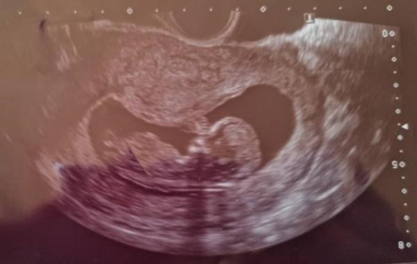 Bild zu Boy or Girl? :) - Schwanger - wer noch? Rund um die Schwangerschaft