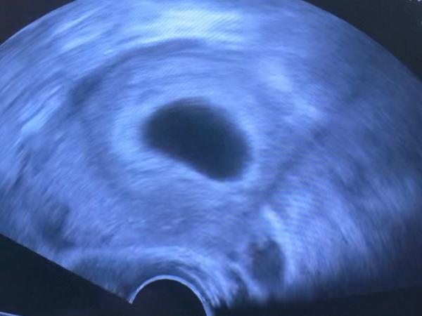 Bild zu Brauche bitte Ultraschallexperten😀 - Schwanger - wer noch? Rund um die Schwangerschaft