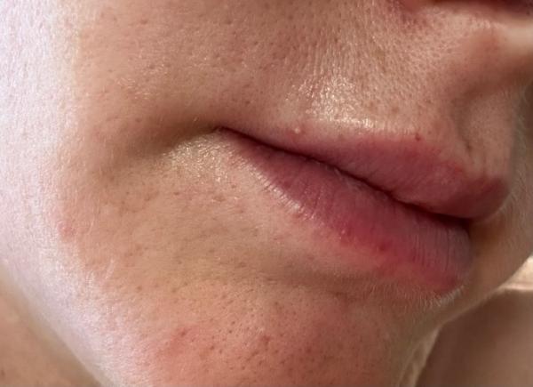 Bild zu Herpes - Schwanger - wer noch? Rund um die Schwangerschaft