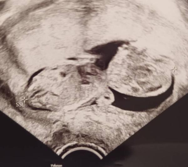 Bild zu Geschlecht erkennen - Schwanger - wer noch? Rund um die Schwangerschaft