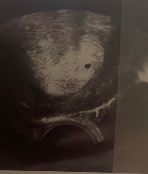 Bild zu Ultraschall 5+3 - Schwanger - wer noch? Rund um die Schwangerschaft
