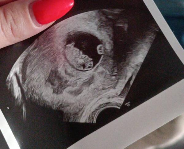 Bild zu Fällt SSL bei unterschiedlicher Schallart anders aus? (Vaginal, Bauchdecke) - Schwanger - wer noch? Rund um die Schwangerschaft