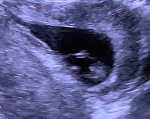 Bild zu 13+4 Junge oder Mädchen?💙💖 - Schwanger - wer noch? Rund um die Schwangerschaft