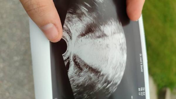 Bild zu Freie Flüssigkeit - Schwanger - wer noch? Rund um die Schwangerschaft