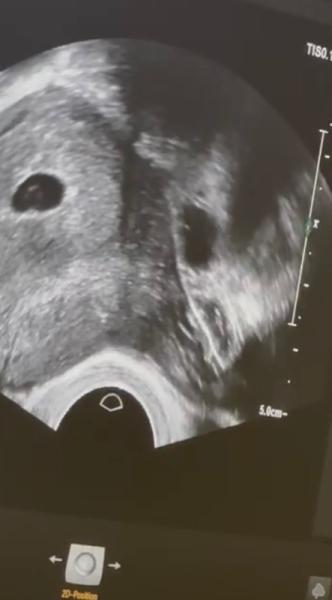 Bild zu Ultraschall, zwillinge? - Schwanger - wer noch? Rund um die Schwangerschaft