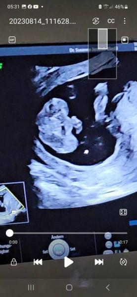 Bild zu Könnt ihr erkennen was es wird ? 19+5 - Schwanger - wer noch? Rund um die Schwangerschaft