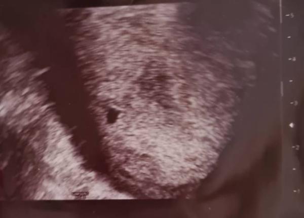 Bild zu Schmerzen 5+2 ssw - Schwanger - wer noch? Rund um die Schwangerschaft