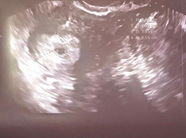 Bild zu Ultraschall normal? - Schwanger - wer noch? Rund um die Schwangerschaft