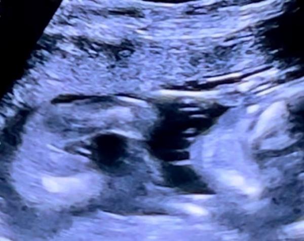 Bild zu Junge oder Mädchen ? 💙💖 - Schwanger - wer noch? Rund um die Schwangerschaft