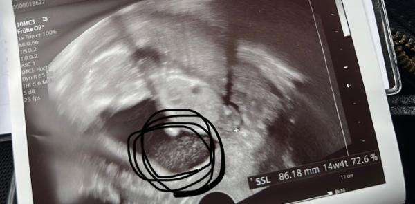 Bild zu Weiße Flecken im Ultraschall - Schwanger - wer noch? Rund um die Schwangerschaft