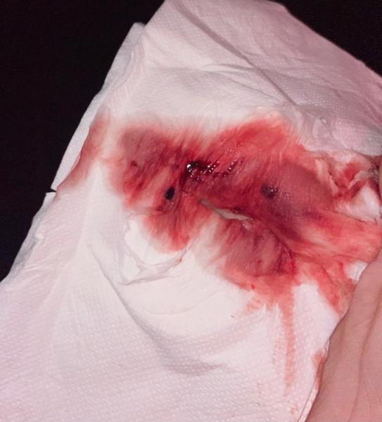 Bild zu Tiefrote frische Blutung 6Ssw - Schwanger - wer noch? Rund um die Schwangerschaft