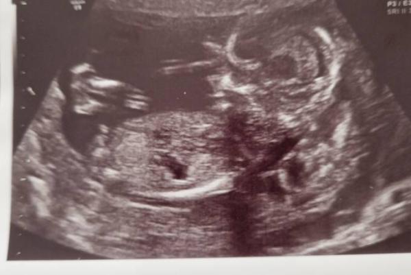 Bild zu Mädchen oder Junge - Schwanger - wer noch? Rund um die Schwangerschaft