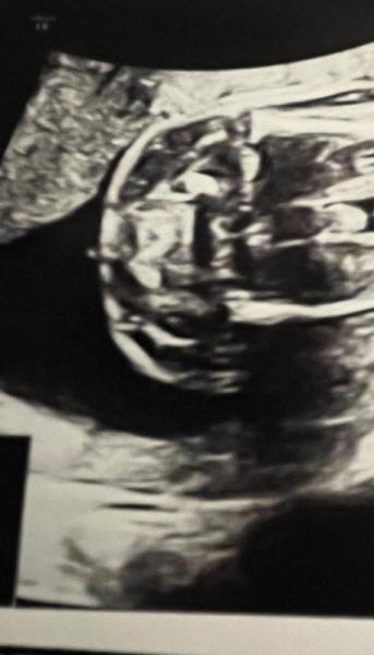 Bild zu Bub oder mädchen - Schwanger - wer noch? Rund um die Schwangerschaft