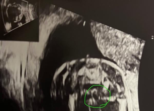 Bild zu Babgeschlecht - Schwanger - wer noch? Rund um die Schwangerschaft