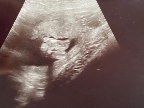 Bild zu Babygeschlecht - Schwanger - wer noch? Rund um die Schwangerschaft