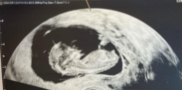 Bild zu Mädchen oder Jungen - Schwanger - wer noch? Rund um die Schwangerschaft