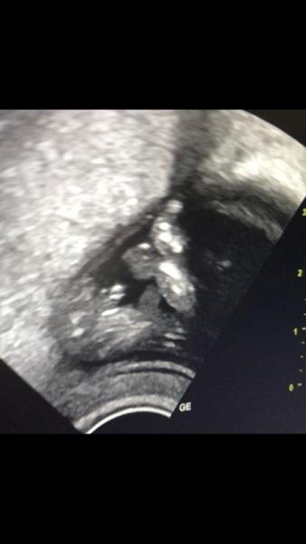 Bild zu Eindeutiger babyboy? đź’™ - Schwanger - wer noch? Rund um die Schwangerschaft