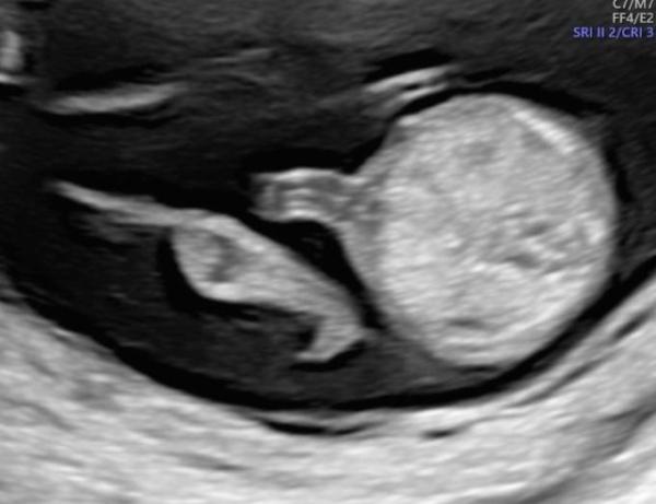 Bild zu Geschlecht 14 SSW - Schwanger - wer noch? Rund um die Schwangerschaft