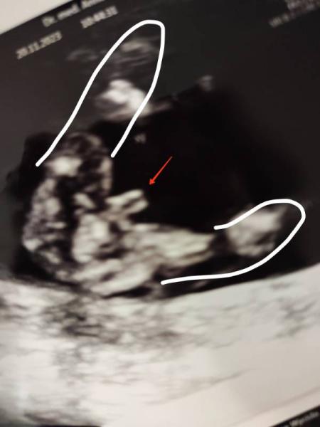 Bild zu Hiiilfe - Junge oder Mädchen? :) - Schwanger - wer noch? Rund um die Schwangerschaft