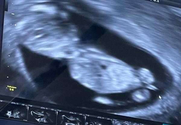 Bild zu Tendenz junge ?! - Schwanger - wer noch? Rund um die Schwangerschaft