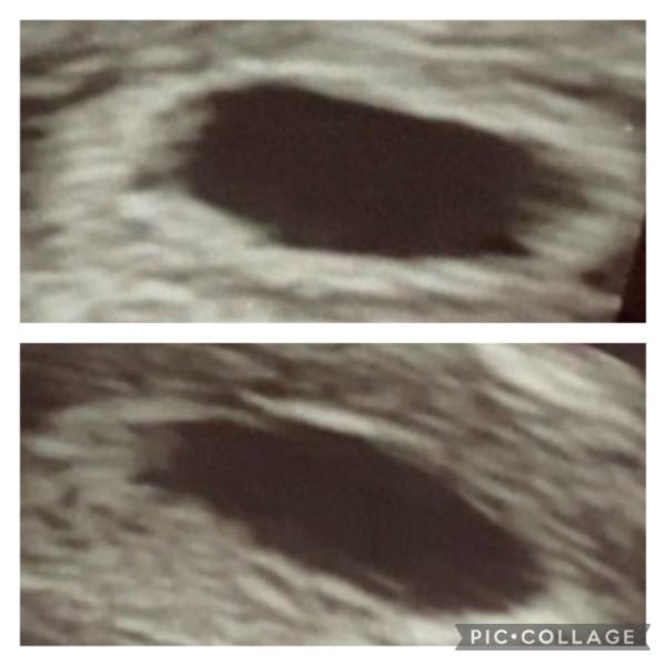 Bild zu Meine Ultraschall Bilder verwirren mich - Schwanger - wer noch? Rund um die Schwangerschaft